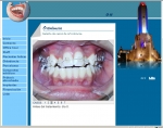 Implantes dentales que son? como se coloca? duele? fracasa?