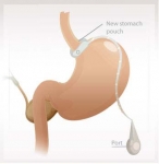 Tratamiento de banda bástrica para obesos