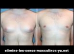 Eliminar grasa pectorales