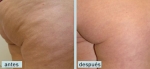 Eliminar  La Celulitis En Los Muslos