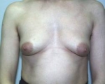 Senos masculinos.Como eliminarlos.