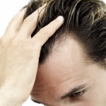 Terapia de Células Madre para Evitar la Calvicie