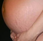 Como Quitar  la  estrias  y  para  siempre