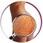 Celulitis en Mujeres