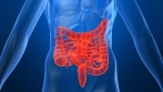 Síndrome Del Colon Irritable (Sci), El Caos En Los Intestinos