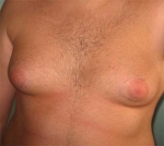 Cómo curar la grasa del pecho en los hombres