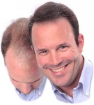 6 Tratamiento natural para la pérdida del cabello 