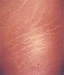 Aprende Algunas Formas De Eliminar Las Estrías Blancas