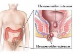 Algunos mitos y verdades sobre las hemorroides, no trague entero todo lo que le dicen.