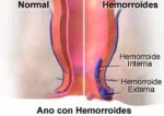 ¿Qué son las hemorroides o almorranas?