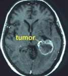 Los Tratamientos del cáncer