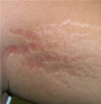 He Logrado Eliminar las Estrias