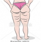 Celulitis :Los factores de riesgo 